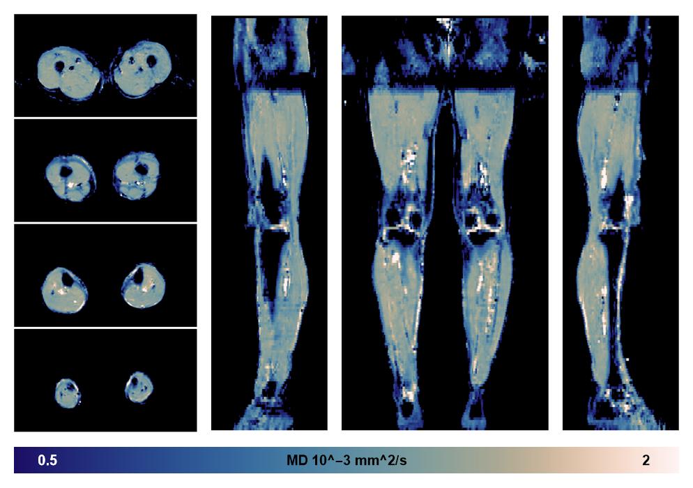 IVIM corrected whole leg muscle mean diffusivity obtained from diffusion tensor imaging.